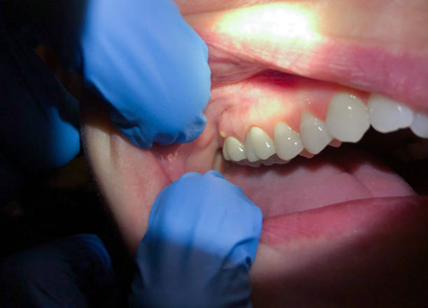 Best Emergency Dentist for Lost Fillings or Crowns in New Tazewell, TN